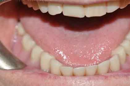 Dentures 3